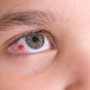 Red Spot
